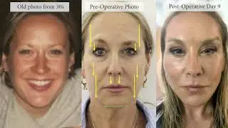 Dr De Silva&rsquo;s Vertical Face Restore 7, VFR-7, Signature facelift & neck lift from  30s to now