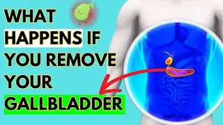 What Happens If You Remove Your Gallbladder? (Must Know!)