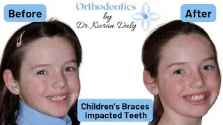 Prevention of the Impaction of Teeth