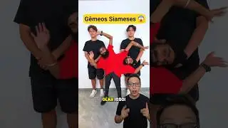 G&ecirc;meos Siameses 😱 #medicina #medico #enfermagem #enfermeiro #enfermeira #gemeos #g&ecirc;meos #g&ecirc;meas