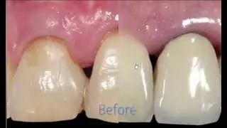 Zirconia allceramic crown restoration