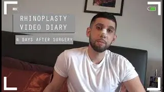 Rhinoplasty video diary - 4 days after surgery (5/15)