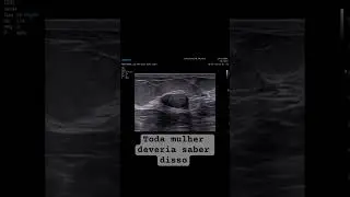 A diferen&ccedil;a entre o c&acirc;ncer de mama e o n&oacute;dulo benigno