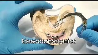sovrastruttura tipo scheletrico su Barra con ritenzione avvitata su impianti dentali