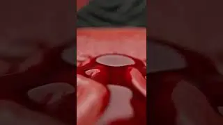 A bleeding gastric ulcer 3D