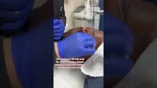 RF Microneedling in Dallas Tx
