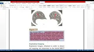 LECTURE ON CT  SCAN PROTOCOLS , CT CHEST,HRCT CHEST ,HRCT CHEST DYNAMIC ,CT ABDOMEN, CT MULTIPHASIC