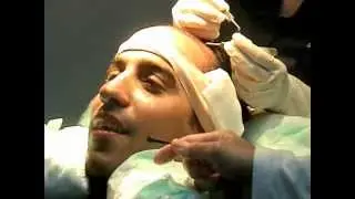 Trasplante de pelo al Sr. Jhoel Lopez por la doctora Alba Reyes