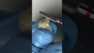 DIENTE PROVISORIO DE ACR&Iacute;LICO 😲 #acrilico #diente #dentista #dientes #odontologia #clinica #arg