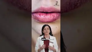 Do Kids Need Lip Balm? | Lip Balm for Kids | Lips Treatment in Rhishikesh | Dr. Sridevi Esthetiques