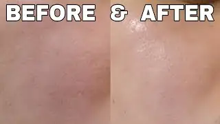 Paano Sumikip ang PORES? Super Affordable Treatment!