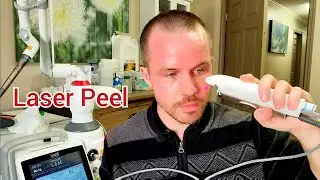 Light Laser Peel with a Fotona Dynamis Erbium Yag