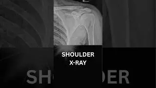 Shoulder X-Ray (AP View) | How I Read a Normal X-Ray in Clinical Practice
