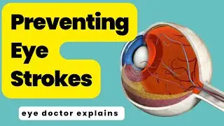 Stop vision loss from eye strokes | central retinal vein occulsion | glaucoma doctor