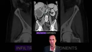 Renal cell carcinoma CT interpretation #radiology #medicalstudent #radiologist #radiographer