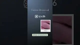 Tattoo Removal for ALL Skin Types! @spa26
