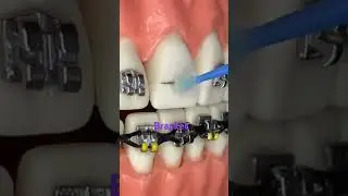 How braces Bracket will be Placed on tooth|Bracket|Orthodontic Treatment🦷