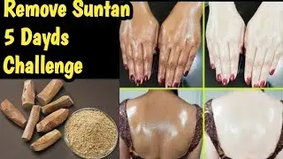 Summer Special Rice Whitening Brightening Cream | Remove Dark Spots | Pigmentation Dark Skin Sun Tan