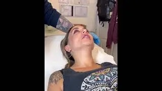 An example of cryotherapy treatment for small thread veins around the nose