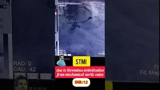 infrolateral STEMI  due to clot embolization from mechanical heart valve, poor INR