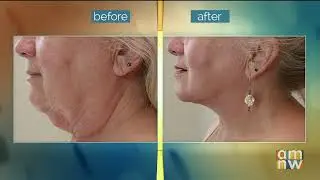 The MiniFaceLift & Threads