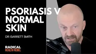 The Difference Between Normal and Psoriasis Skin with Dr Garrett Smith
