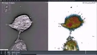 Glioblastoma cells undergoing autophagy observed with holo-tomographic microscope