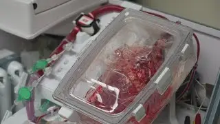 Northwestern heart surgeons successfully transplant heart from donor whose heart stopped beating