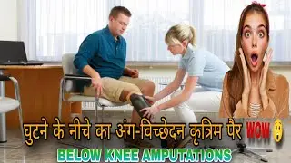 Foot amputation to Below Knee Amputation#trending