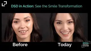DSD in Action: See the Smile Transformation