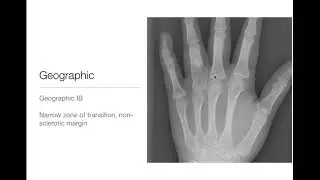 Bone Tumors  - Zone of Transition - Part 1
