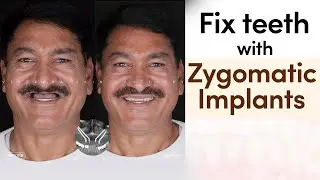 🦷 Fix Teeth with Zygomatic Implants | Smile Design for Dasrath Ji