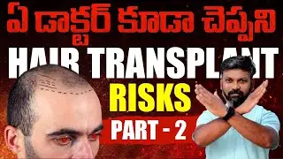 #AskDrJohnWatts | HAIR TRANSPLANT RISKS THAT NO DOCTOR TOLD US PART -2 | Hair Specialist Explains