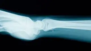 Wrist Xray, pronator fat pad, pronator quadratus,  flexor carpi ulnaris inserting on pisiform