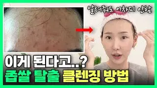 이걸 몰라서 여드름이 생기는 겁니다😱ㅣ알려주기 아까운 좁쌀 여드름 클렌징 방법!