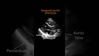 ECHO #Parasternal Long Axis (PSLA) View