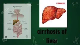 liver cirrhosis/pathophysiology/causes/symptoms/Treatment.Digestive system by Aman sir