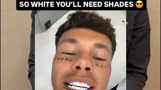 Full crowns, bright white, entirely Miami. Is there such thing as TOO white??#veneers #miami #white