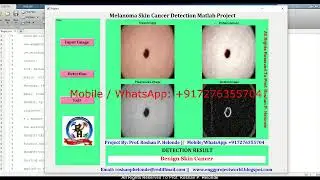 Skin Cancer Detection Using Matlab | Skin Cancer Identification Using Deep Learning FinalYearProject