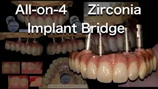 All-on-4 Zirconia Implant Bridge   e.max cream build up  #歯科技工　#Implant #JENSEN #GC