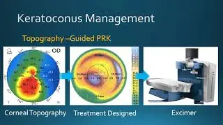 Keratoconus Management: Corneal Crosslinking & Topography-Guided PRK at Bochner Eye in Toronto