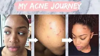 My Acne Journey | How I Cleared My Skin Using Tretinoin