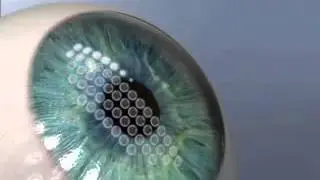Blade Free Lasik