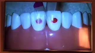 The Bioclear Method: Placing matrices