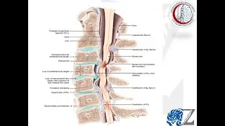 Degenerative Spine (20) : Cervical Spondylosis (1)  خشونة الفقرات العنقية