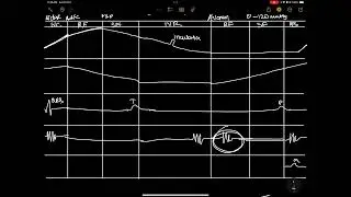 PRESSURE VOLUME CHANGES IN LEFT VENTRICLE I PV LOOP 