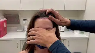 One Week after Hairline Lowering/ Forehead Reduction Surgery