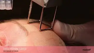 Watch this laser resurface skin