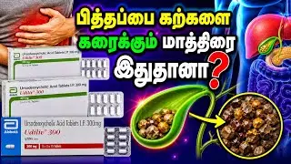 udiliv tablet uses in tamil/பித்தப்பை கல் மருத்துவம்/gall stones treatment