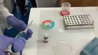 Inmunodifusi&oacute;n radial simple para detecci&oacute;n cuantitativa de Ig G, Ig M y Ig A en suero humano